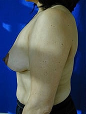 Breast Lift Before & After