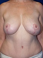 Breast Lift Before & After