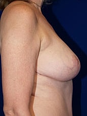 Breast Lift Before & After