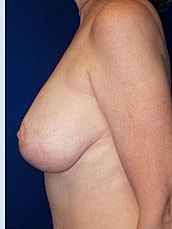 Breast Lift Before & After