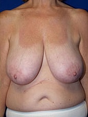 Breast Lift Before & After