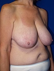 Breast Lift Before & After