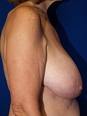Breast Lift Before & After