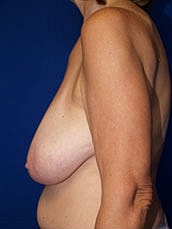 Breast Lift Before & After