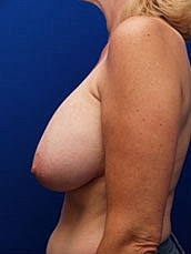 Breast Lift Before & After