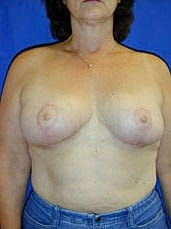 Breast Lift Before & After