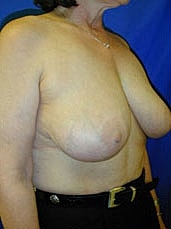 Breast Lift Before & After