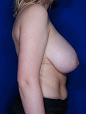 Breast Lift Before & After