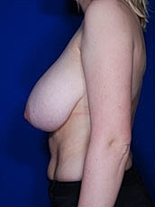Breast Lift Before & After