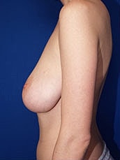 Breast Lift Before & After