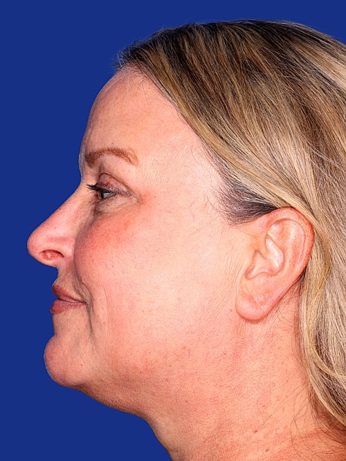 Brow Lift Before & After