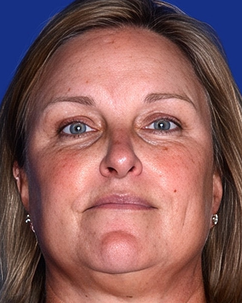 Brow Lift Before & After