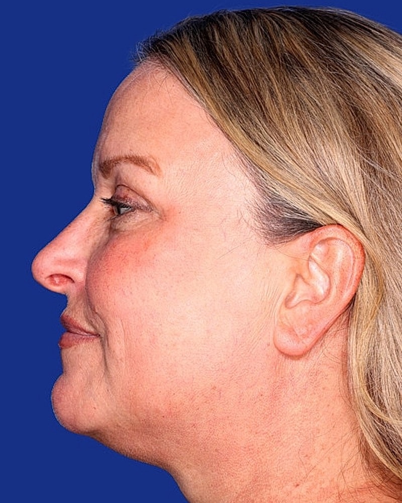 Brow Lift Before & After
