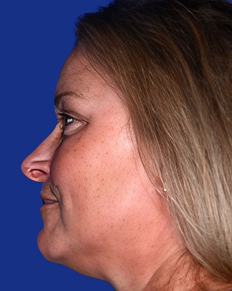 Brow Lift Before & After