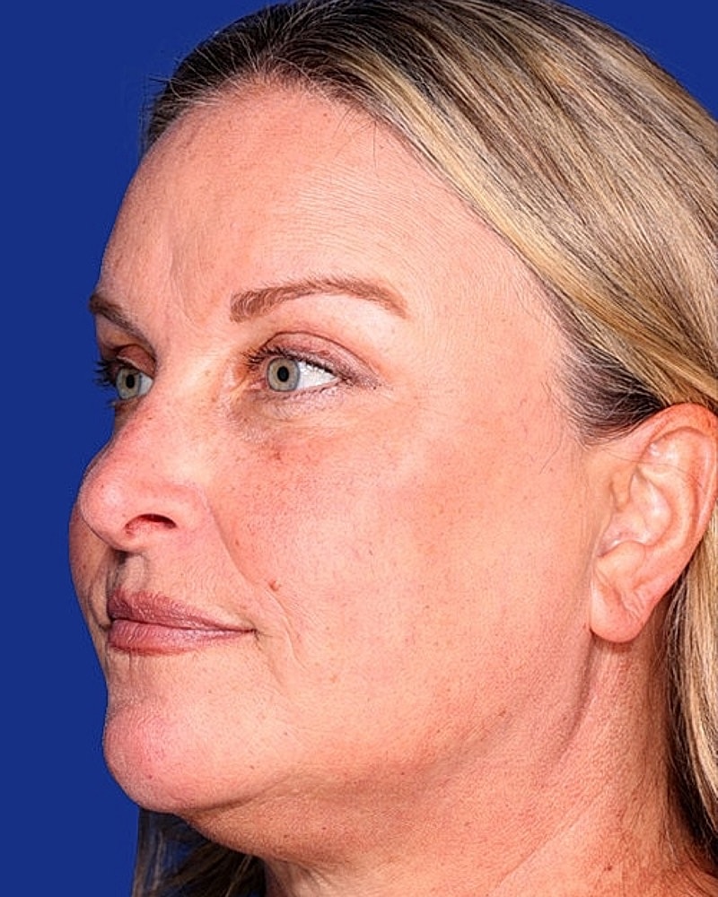 Brow Lift Before & After