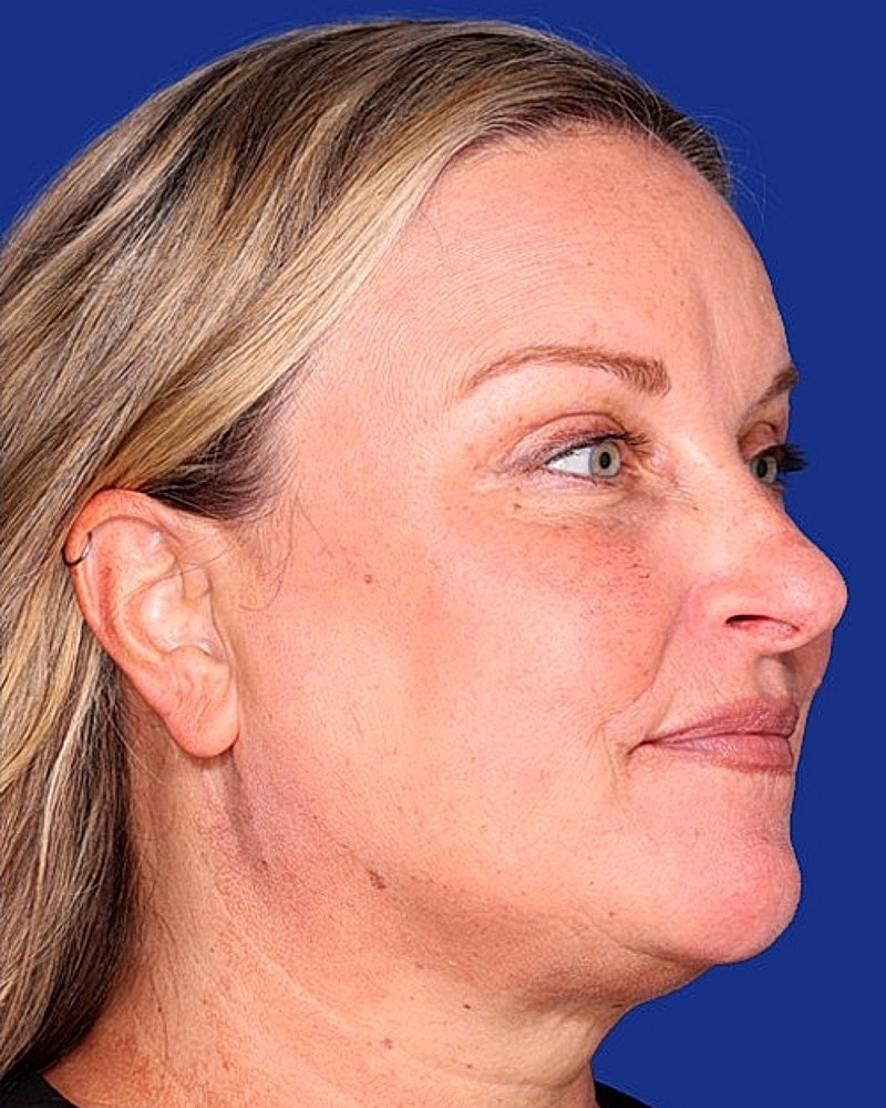 Brow Lift Before & After