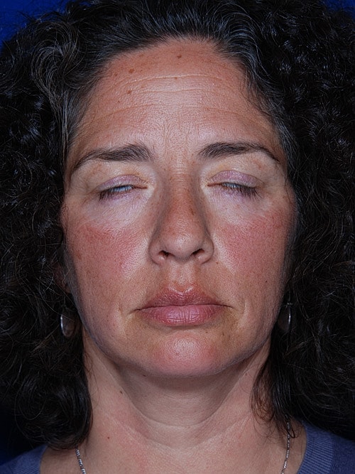 Brow Lift Before & After