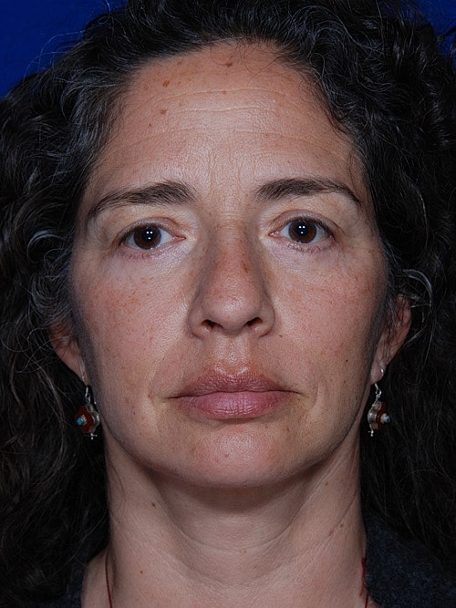 Brow Lift Before & After