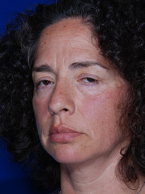 Brow Lift Before & After