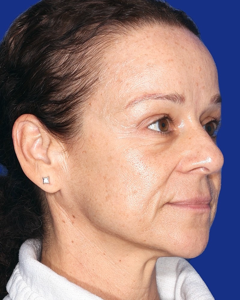 Brow Lift Before & After