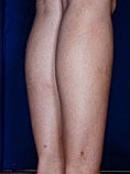 Calf Ankle Liposuction Before & After