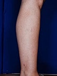Calf Ankle Liposuction Before & After