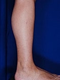 Calf Ankle Liposuction Before & After