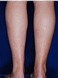 Calf Ankle Liposuction Before & After