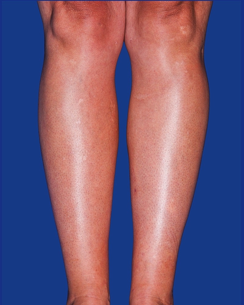 Calf Ankle Liposuction Before & After