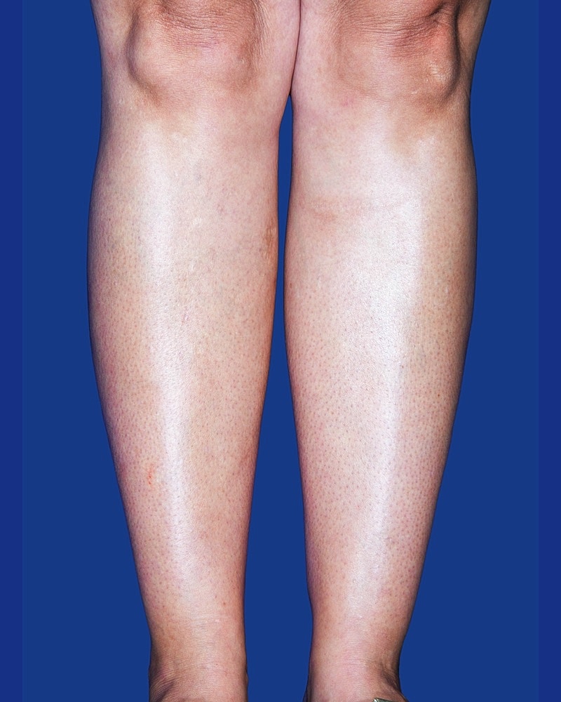 Calf Ankle Liposuction Before & After