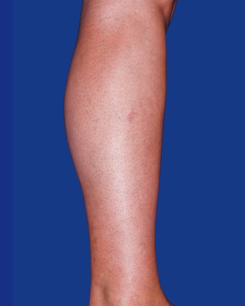 Calf Ankle Liposuction Before & After