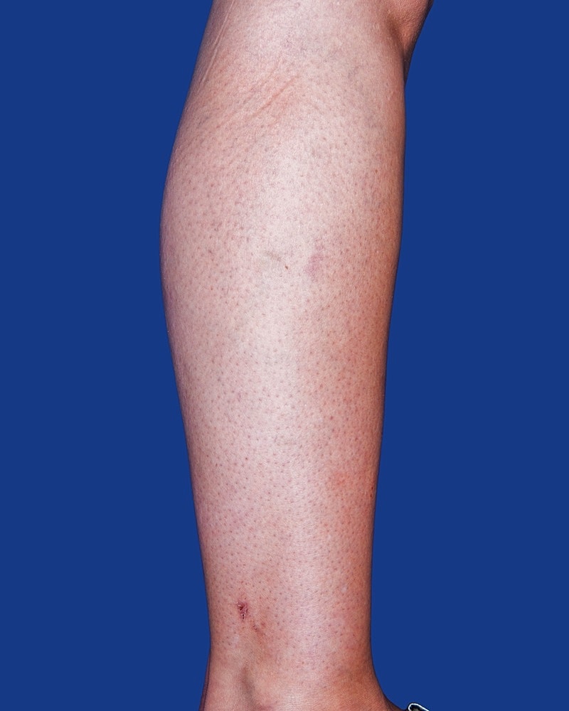Calf Ankle Liposuction Before & After