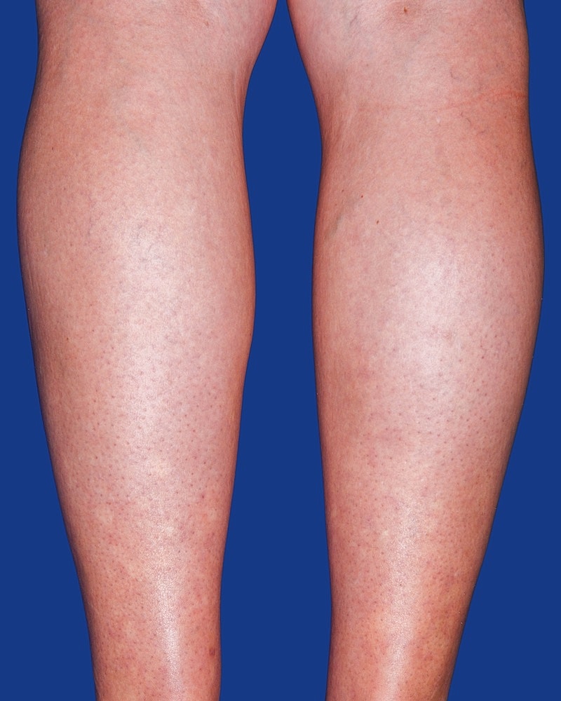 Calf Ankle Liposuction Before & After
