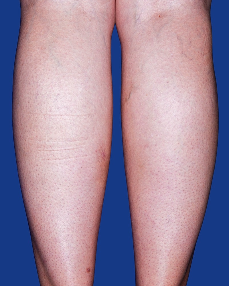 Calf Ankle Liposuction Before & After