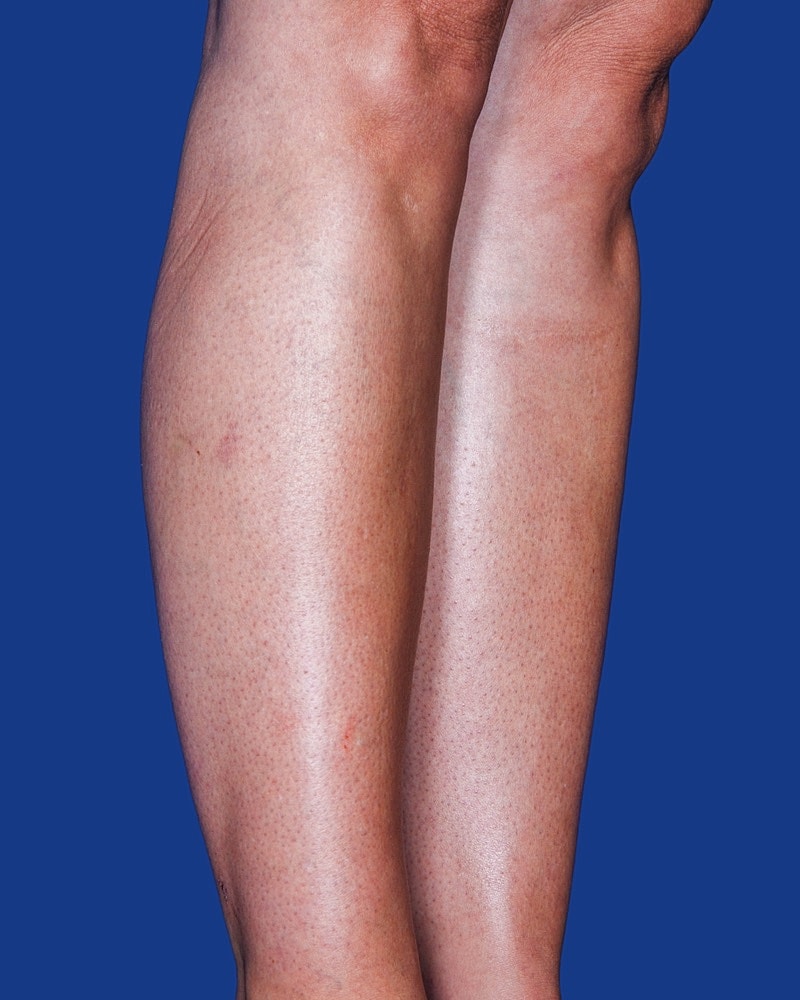 Calf Ankle Liposuction Before & After