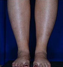 Calf Ankle Liposuction Before & After