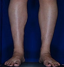 Calf Ankle Liposuction Before & After