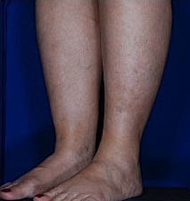 Calf Ankle Liposuction Before & After