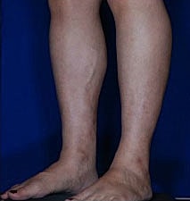 Calf Ankle Liposuction Before & After