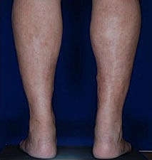 Calf Ankle Liposuction Before & After
