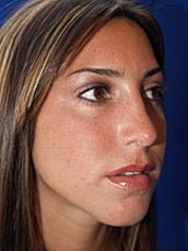 Rhinoplasty Before & After
