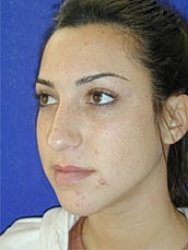 Rhinoplasty Before & After