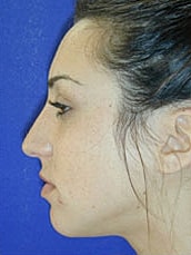 Rhinoplasty Before & After