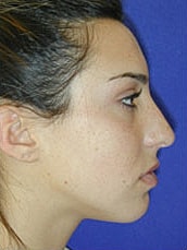 Rhinoplasty Before & After