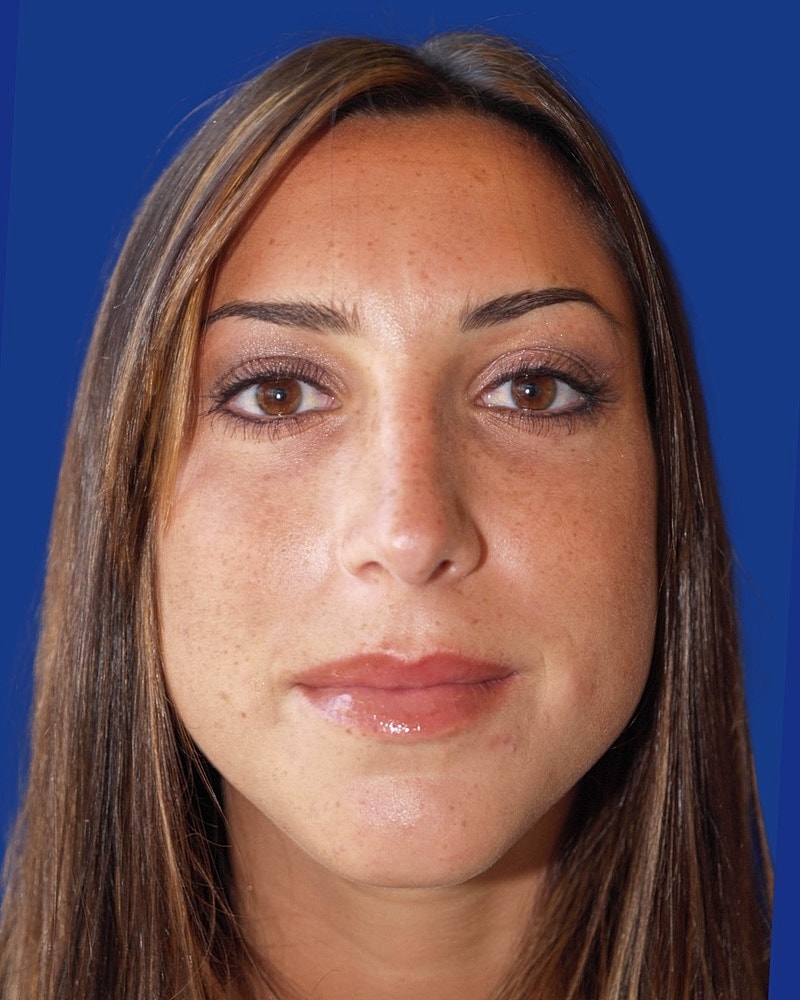 Rhinoplasty Before & After