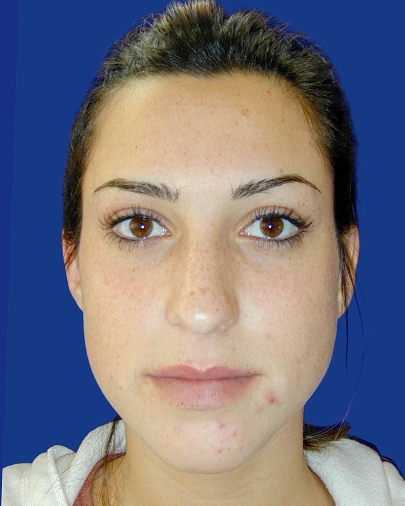 Rhinoplasty Before & After