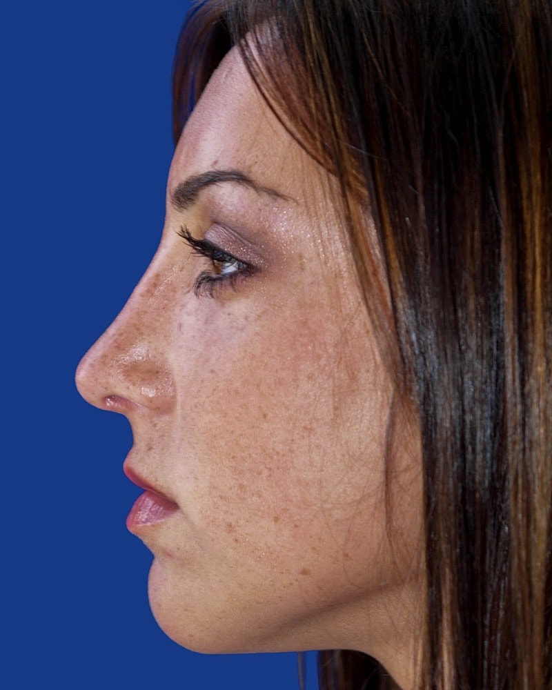 Rhinoplasty Before & After