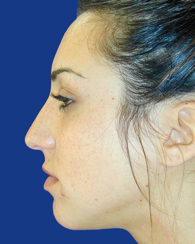 Rhinoplasty Before & After