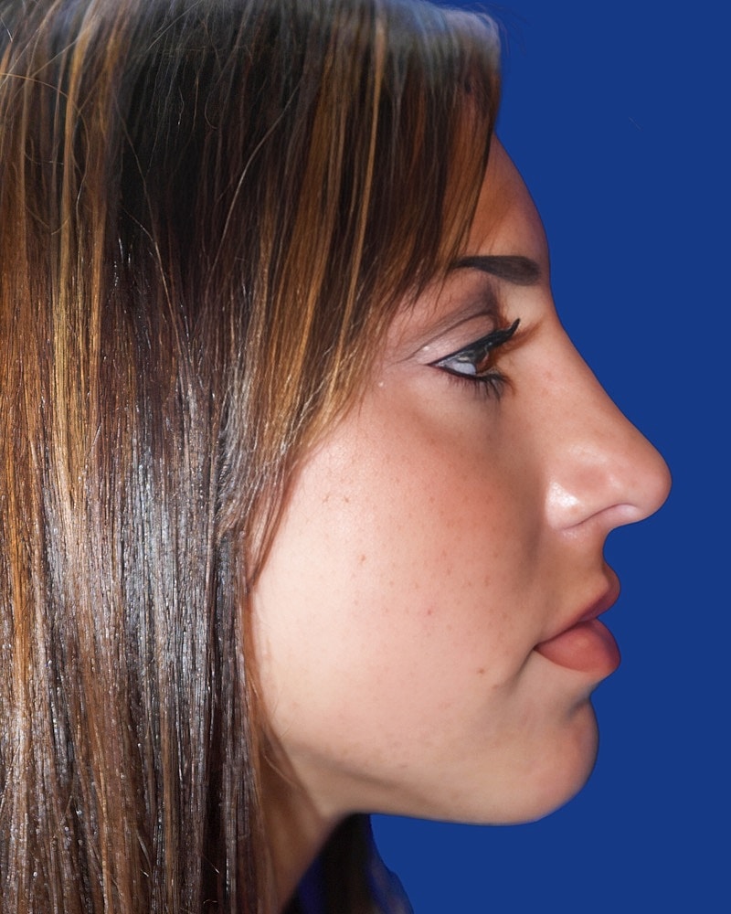 Rhinoplasty Before & After