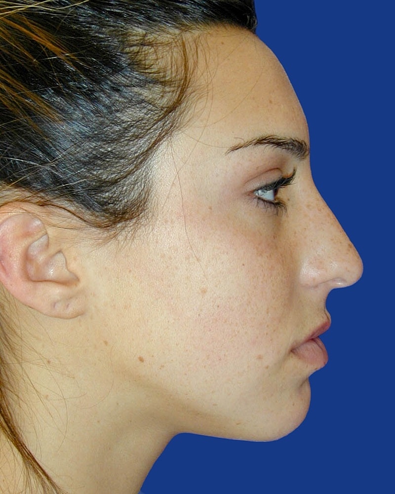 Rhinoplasty Before & After